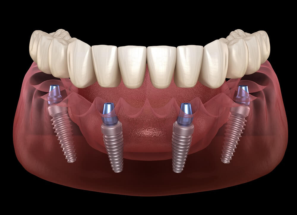 Sedation options for dental implant surgery
